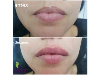 Aumento labios - 634353