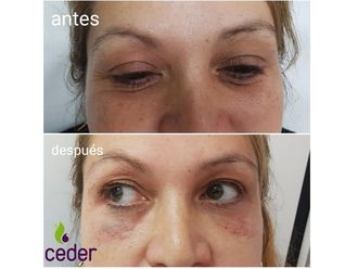 Blefaroplastia sin cirugía - 634354