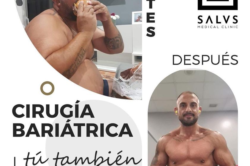 Manga gástrica antes y después - 810089