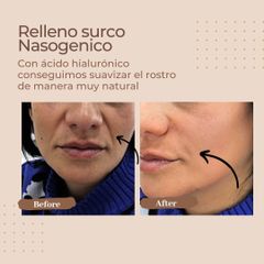 Rellenos faciales - Salus Medical Clinic Granada
