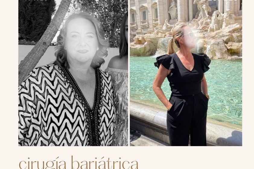 Tratamiento obesidad antes y después - 845854