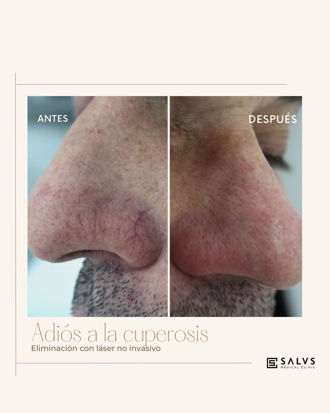 Cuperosis Antes y después - Multiestetica.com - Multiestetica.com