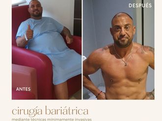 Tratamiento obesidad antes y después - 845861