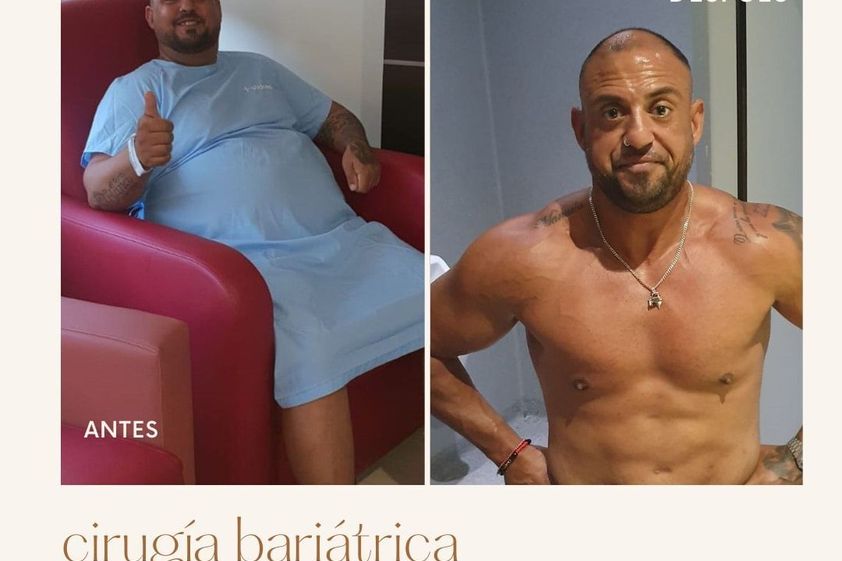 Tratamiento obesidad antes y después - 845861