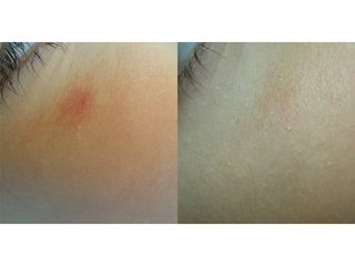 Láser vascular - Dra. Marta Torres