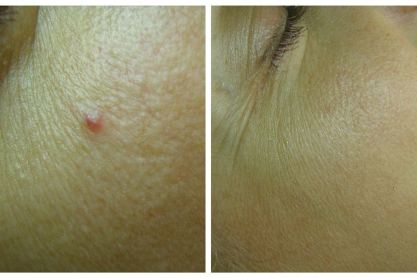 Láser vascular antes y después - 816551