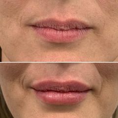 Aumento labios ácido hialurónico