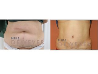 Antes y después Abdominoplastia