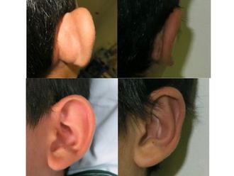 Otoplastia - 636432
