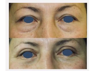 Blefaroplastia - 650274