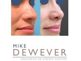 Rinoplastia - 661849