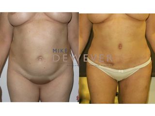 Antes y después Abdominoplastia con liposucción de piernas - Clinica Belba