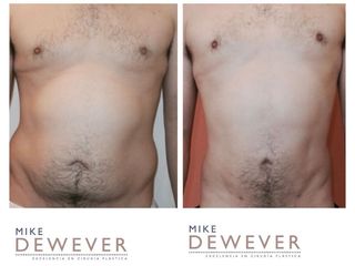 Antes y después Liposucción - Clinica Belba