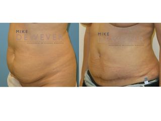 Antes y después Abdominoplastia con liposucción de flancos - Clinica Belba