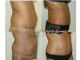 Antes y después Abdominoplastia con liposucción de flancos - Clinica Belba