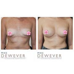 Antes y después Mamas tuberosas - Clinica Belba