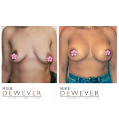 Antes y después Mamas tuberosas - Clinica Belba