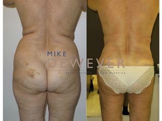 Antes y después Lipoescultura - Clinica Belba