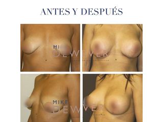 Antes y después mastopexia
