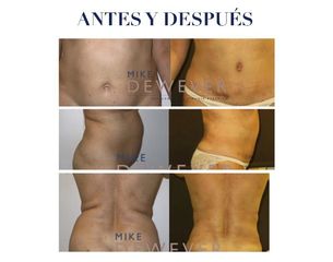 Antes y después Liposucción