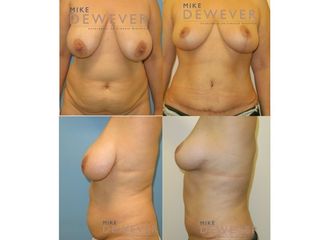 Antes y después Abdominoplastia con pexia - Clinica Belba