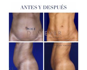 Antes y después Liposucción - Clinica Belba