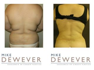 Antes y después Liposucción - Clinica Belba