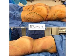 Antes y después Liposucción - Clinica Belba