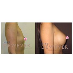 Antes y después Aumento con prótesis redondas, 365cc - Clinica Belba
