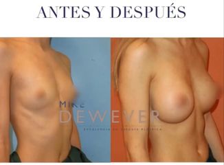 Antes y después Aumento de pecho, prótesis anatómicas 350cc - Clinica Belba