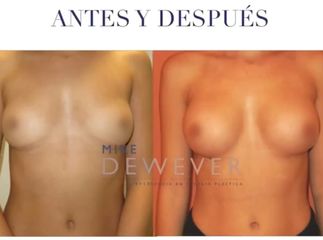 Antes y después Aumento de mama con prótesis redonda 285cc - Clinica Belba