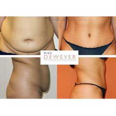 Antes y después Abdominoplastia - Clinica Belba