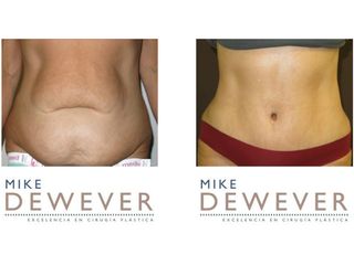 Antes y después Abdominoplastia - Clinica Belba