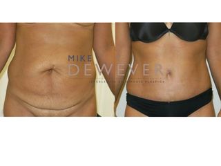 Antes y después Abdominoplastia con liposucción de flancos - Clinica Belba