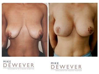 Antes y después Mastopexia con prótesis - Clinica Belba