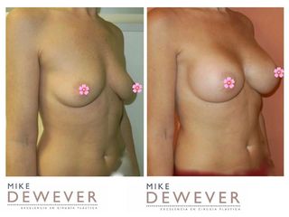 Antes y después Mastopexia - Clinica Belba