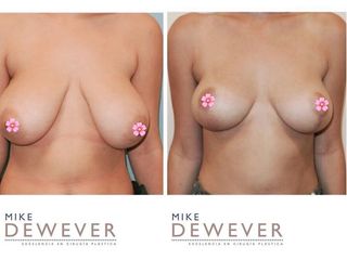 Antes y después Mastopexia - Clinica Belba