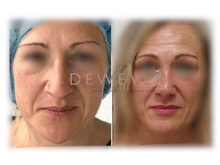 Antes y después Rinoplastia - Clinica Belba