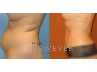 Antes y después Liposucción - Clinica Belba