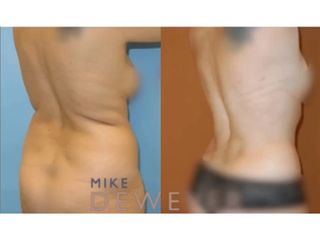 Antes y después Liposucción - Clinica Belba
