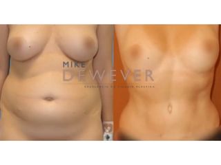 Antes y después Liposucción - Clinica Belba