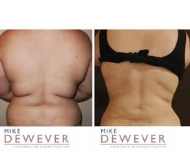 Liposucción - Clinica Belba