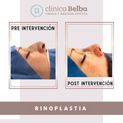 Rinoplastia - Clinica Belba