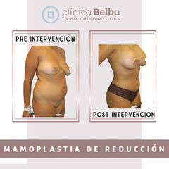 Reducción de senos - Clinica Belba