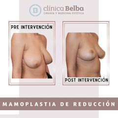 Reducción de senos - Clinica Belba