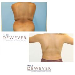 Liposucción - Clinica Belba