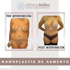 Aumento de pecho - Clinica Belba