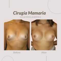 Aumento de pecho - Clinica Belba