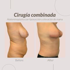 Liposucción - Clinica Belba