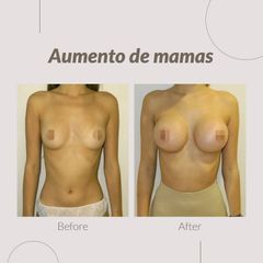 Aumento de pecho - Clinica Belba